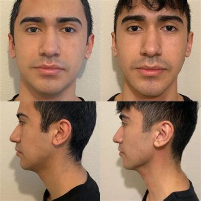 Does Jaw Training Work? Exploring the Myths and Realities of Facial Fitness